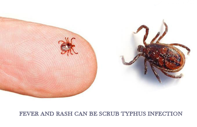 Scrub typhus cases on the rise in Baitadi