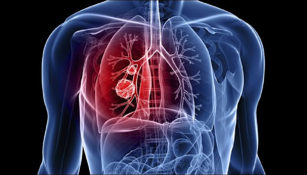 Tuberculosis to be eradicated from Nepal by 2050