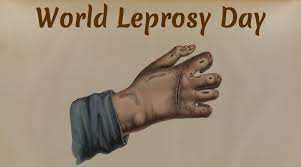 Madhesh Province records 40 percent of country’s total leprosy cases